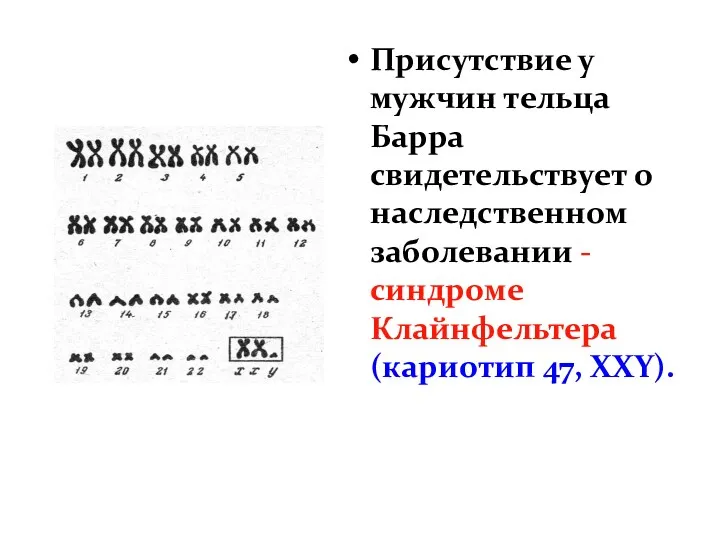 Присутствие у мужчин тельца Барра свидетельствует о наследственном заболевании - синдроме Клайнфельтера (кариотип 47, ХХY).