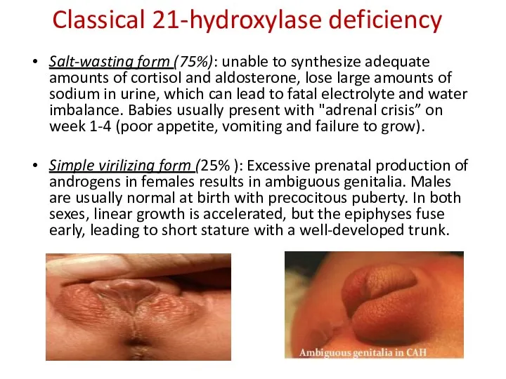 Classical 21-hydroxylase deficiency Salt-wasting form (75%): unable to synthesize adequate