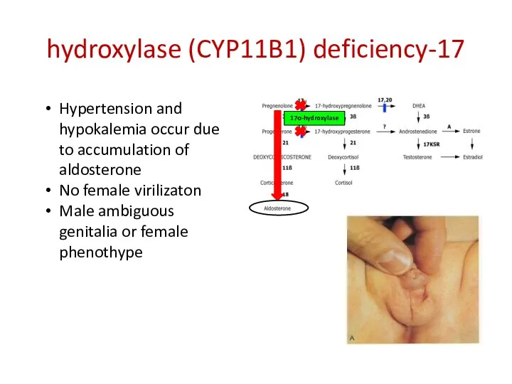 17-hydroxylase (CYP11B1) deficiency 17α-hydroxylase Hypertension and hypokalemia occur due to