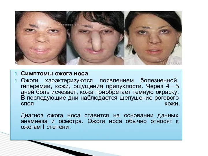 Симптомы ожога носа Ожоги характеризуются появлением болезненной гиперемии, кожи, ощущения