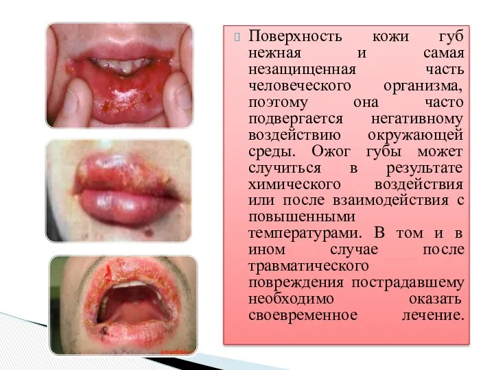 Поверхность кожи губ нежная и самая незащищенная часть человеческого организма,