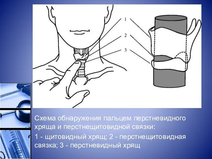 Схема обнаружения пальцем перстневидного хряща и перстнещитовидной связки: 1 - щитовидный хрящ; 2