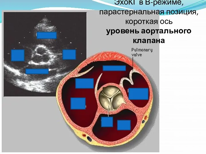 ЭхоКГ в В-режиме, парастернальная позиция, короткая ось уровень аортального клапана