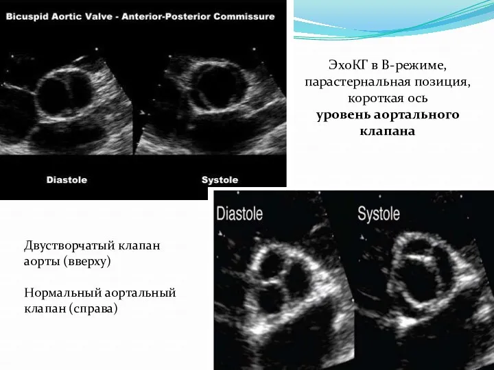 ЭхоКГ в В-режиме, парастернальная позиция, короткая ось уровень аортального клапана