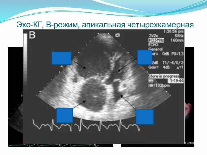 Эхо-КГ, В-режим, апикальная четырехкамерная позиция = апикальная позиция от верхушки