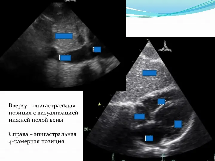 Вверху – эпигастральная позиция с визуализацией нижней полой вены Справа – эпигастральная 4-камерная позиция