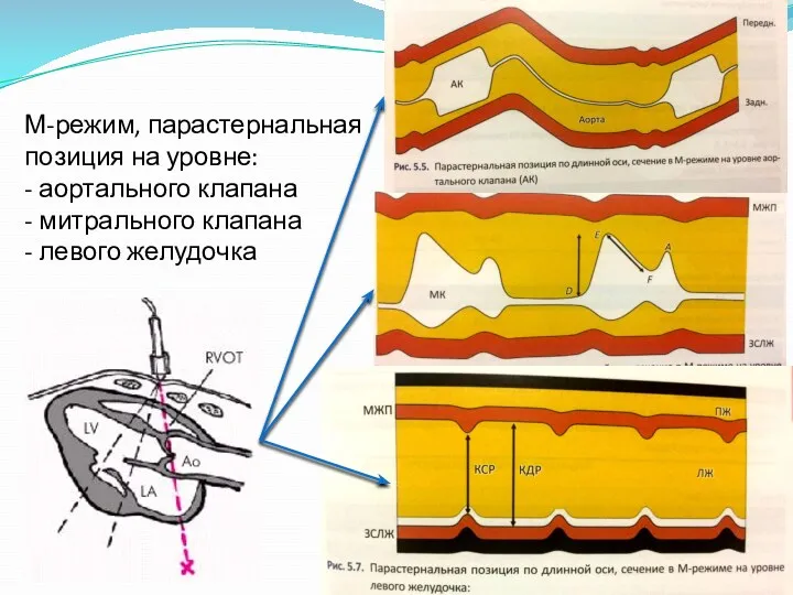 М-режим, парастернальная позиция на уровне: - аортального клапана - митрального клапана - левого желудочка