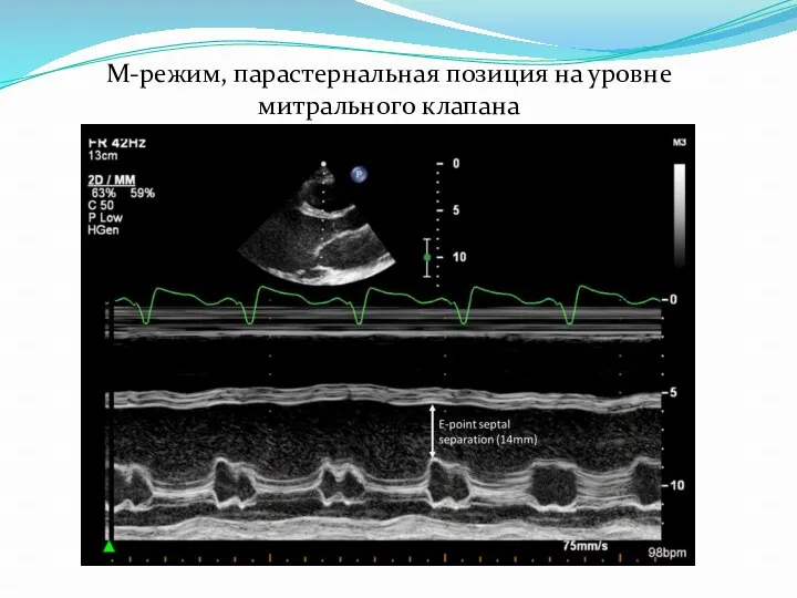 М-режим, парастернальная позиция на уровне митрального клапана
