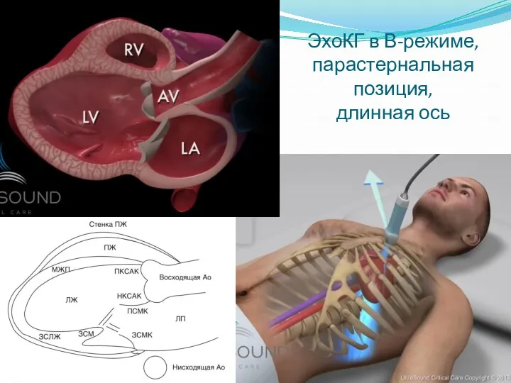 ЭхоКГ в В-режиме, парастернальная позиция, длинная ось