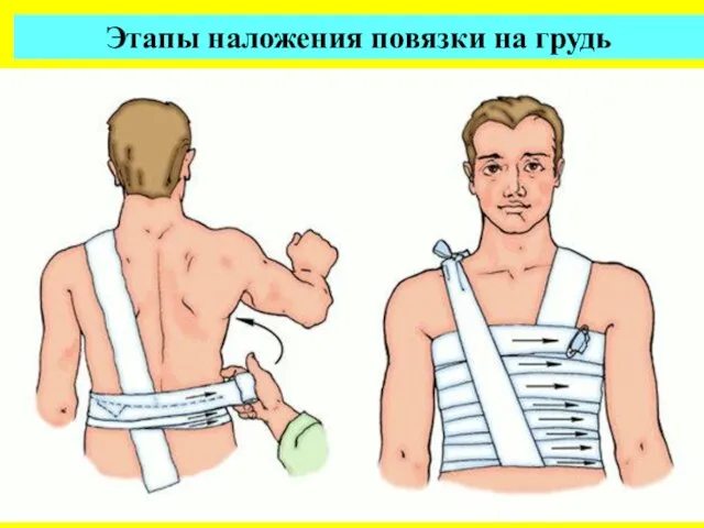Этапы наложения повязки на грудь