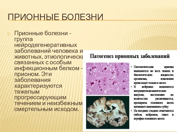 ПРИОННЫЕ БОЛЕЗНИ Прионные болезни - группа нейродегенеративных заболеваний человека и