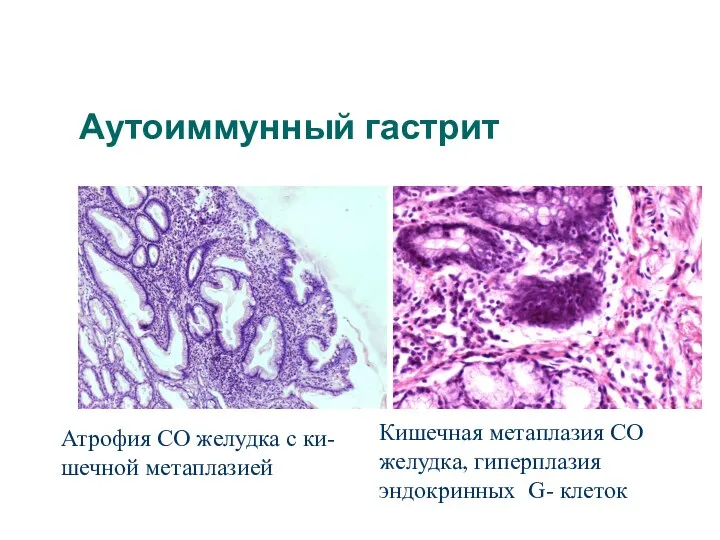 Аутоиммунный гастрит Атрофия СО желудка с ки- шечной метаплазией Кишечная