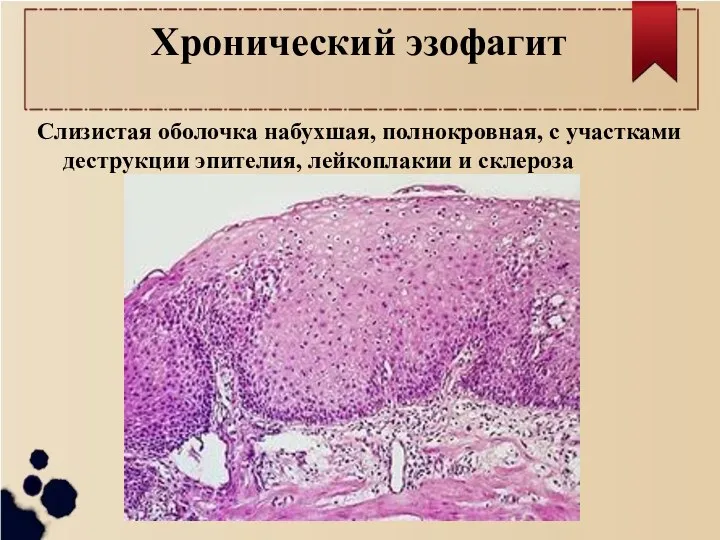 Хронический эзофагит Слизистая оболочка набухшая, полнокровная, с участками деструкции эпителия, лейкоплакии и склероза