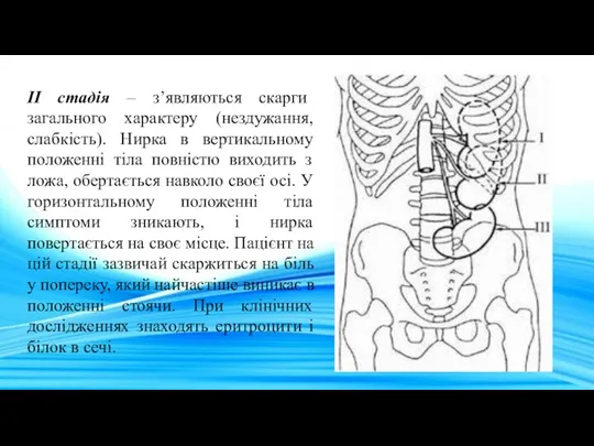 II стадія – з’являються скарги загального характеру (нездужання, слабкість). Нирка