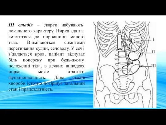 III стадія – скарги набувають локального характеру. Нирка здатна зміститися