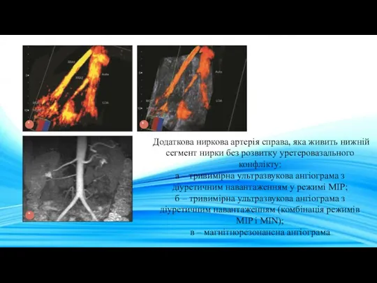 Додаткова ниркова артерія справа, яка живить нижній сегмент нирки без