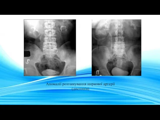 Аномалії розташування ниркової артерії (дистопія)