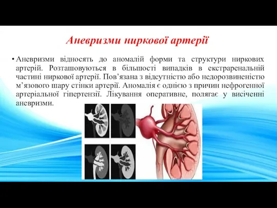 Аневризми ниркової артерії Аневризми відносять до аномалій форми та структури