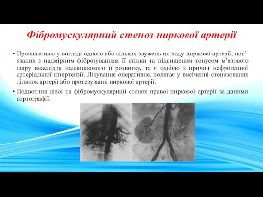 Фібромускулярний стеноз ниркової артерії Проявляється у вигляді одного або кількох