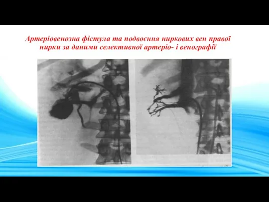 Артеріовенозна фістула та подвоєння ниркових вен правої нирки за даними селективної артеріо- і венографії