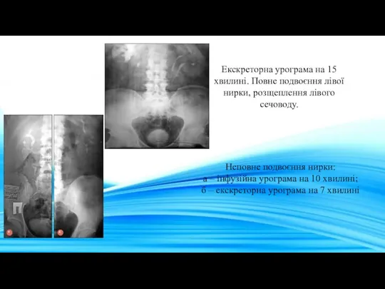 Екскреторна урограма на 15 хвилині. Повне подвоєння лівої нирки, розщеплення