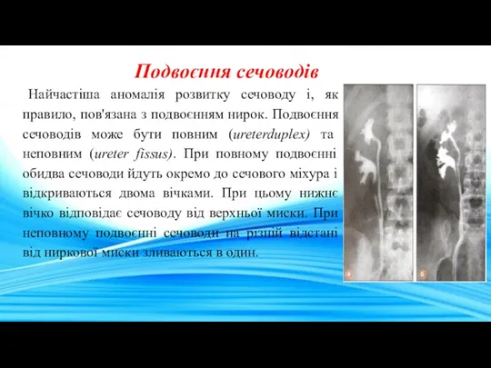 Подвоєння сечоводів Найчастіша аномалія розвитку сечоводу і, як правило, пов'язана