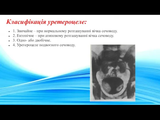 Класифікація уретероцеле: 1. Звичайне – при нормальному розташуванні вічка сечоводу.