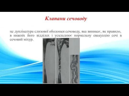 Клапани сечоводу це дуплікатура слизової оболонки сечоводу, яка виникає, як