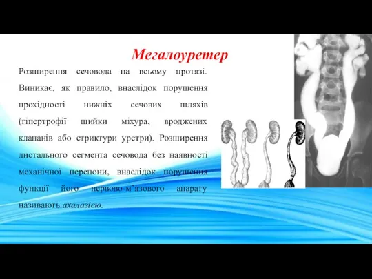 Мегалоуретер Розширення сечовода на всьому протязі. Виникає, як правило, внаслідок