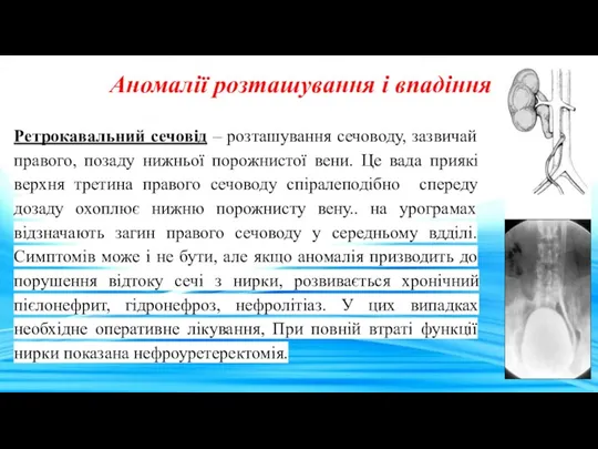 Аномалії розташування і впадіння Ретрокавальний сечовід – розташування сечоводу, зазвичай