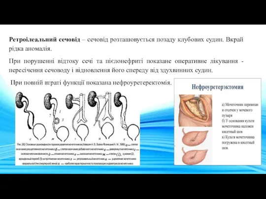 Ретроілеальний сечовід – сечовід розташовується позаду клубових судин. Вкрай рідка