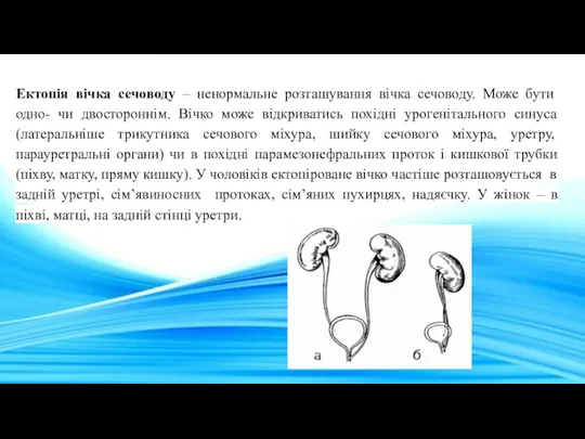 Ектопія вічка сечоводу – ненормальне розташування вічка сечоводу. Може бути