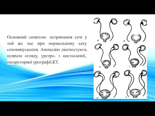 Основний симптом- нетримання сечі у той же час при нормальному