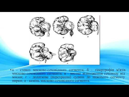 а - стеноз мисково-сечовідного сегмента; б - гіпертрофія м'язів мисково-сечовідного