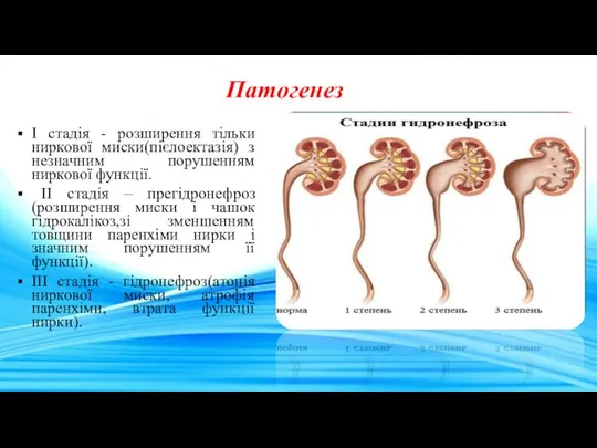 Патогенез I стадія - розширення тільки ниркової миски(пієлоектазія) з незначним