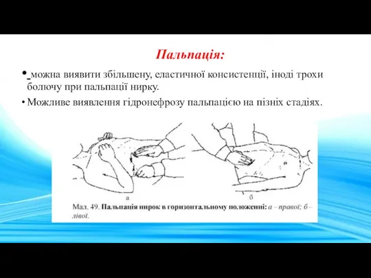 Пальпація: можна виявити збільшену, еластичної консистенції, іноді трохи болючу при