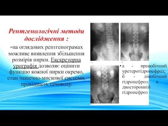 Рентгенологічні методи дослідження : -на оглядових рентгенограмах можливе виявлення збільшення