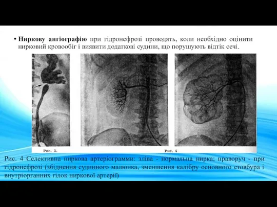 Ниркову ангіографію при гідронефрозі проводять, коли необхідно оцінити нирковий кровообіг