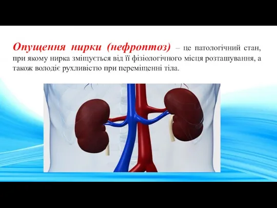 Опущення нирки (нефроптоз) – це патологічний стан, при якому нирка