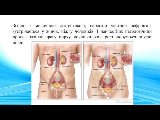 Згідно з медичною статистикою, набагато частіше нефроптоз зустрічається у жінок,