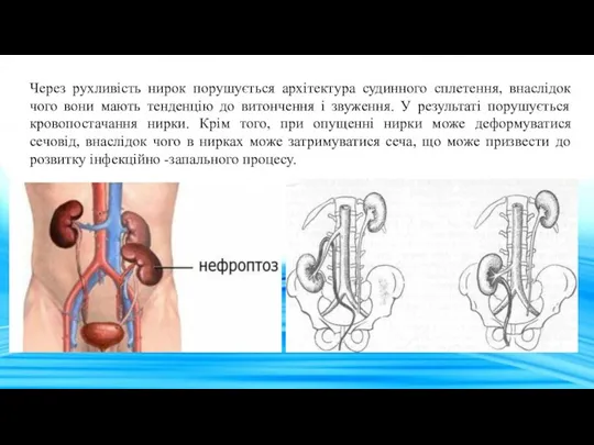 Через рухливість нирок порушується архітектура судинного сплетення, внаслідок чого вони