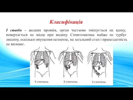 I стадія – жодних проявів, орган частково зміщується на вдиху,