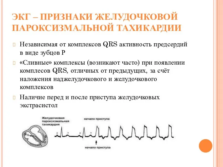 ЭКГ – ПРИЗНАКИ ЖЕЛУДОЧКОВОЙ ПАРОКСИЗМАЛЬНОЙ ТАХИКАРДИИ Независимая от комплексов QRS