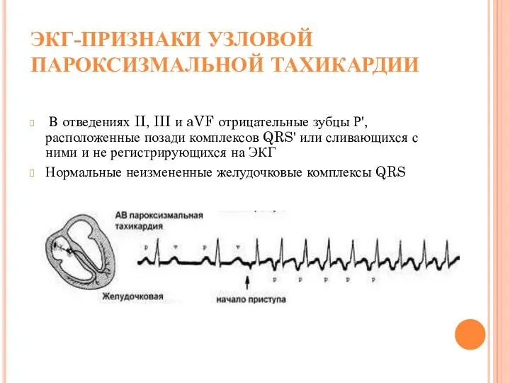 ЭКГ-ПРИЗНАКИ УЗЛОВОЙ ПАРОКСИЗМАЛЬНОЙ ТАХИКАРДИИ В отведениях II, III и aVF