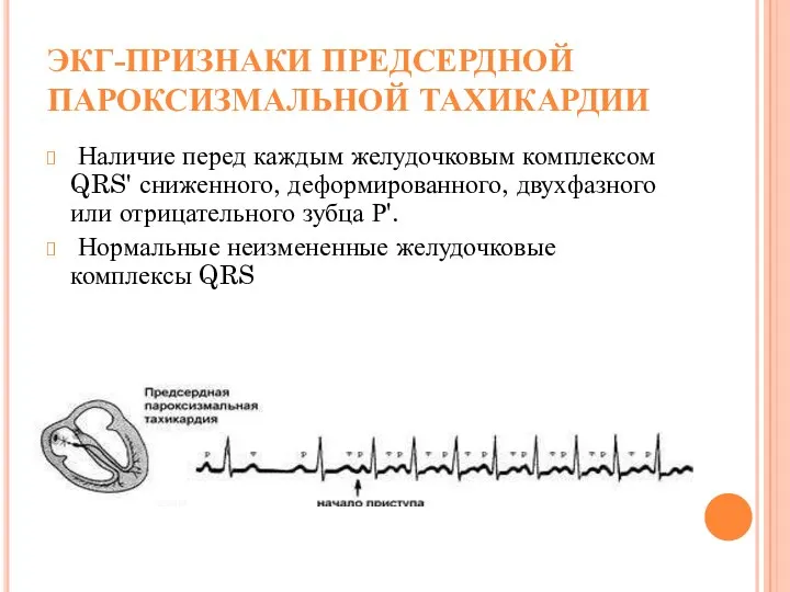 ЭКГ-ПРИЗНАКИ ПРЕДСЕРДНОЙ ПАРОКСИЗМАЛЬНОЙ ТАХИКАРДИИ Наличие перед каждым желудочковым комплексом QRS'