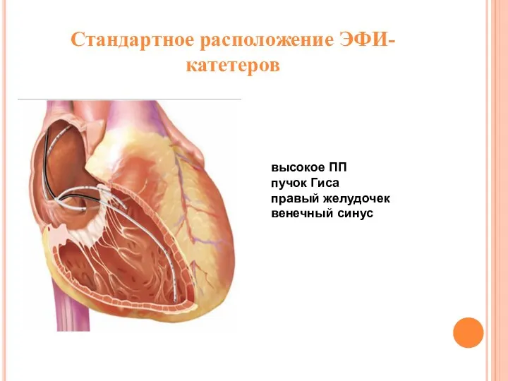 Стандартное расположение ЭФИ-катетеров высокое ПП пучок Гиса правый желудочек венечный синус