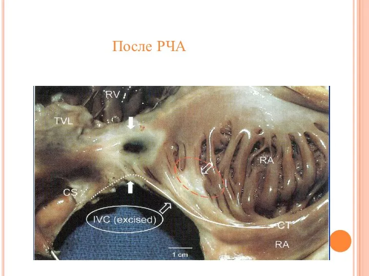 После РЧА