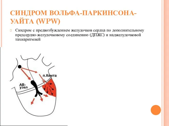 СИНДРОМ ВОЛЬФА-ПАРКИНСОНА-УАЙТА (WPW) Синдром с предвозбуждением желудочков сердца по дополнительному предсердно-желудочковому соединению (ДПЖС) и наджелудочковой тахиаритмией