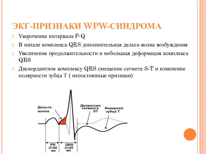 ЭКГ-ПРИЗНАКИ WPW-СИНДРОМА Укорочение интервала P-Q В начале комплекса QRS дополнительная