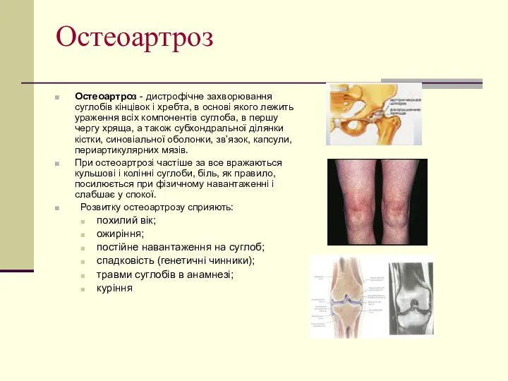 Остеоартроз Остеоартроз - дистрофічне захворювання суглобів кінцівок і хребта, в